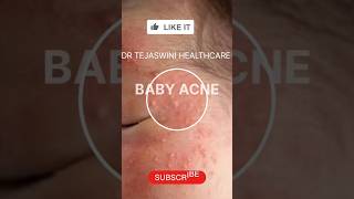 #Baby acne #baby milia#white spots#shorts