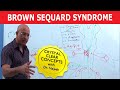 Brown Sequard Syndrome - Internal Medicine