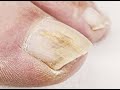Topical medication for toenail fungus | Benjamin Marble DPM