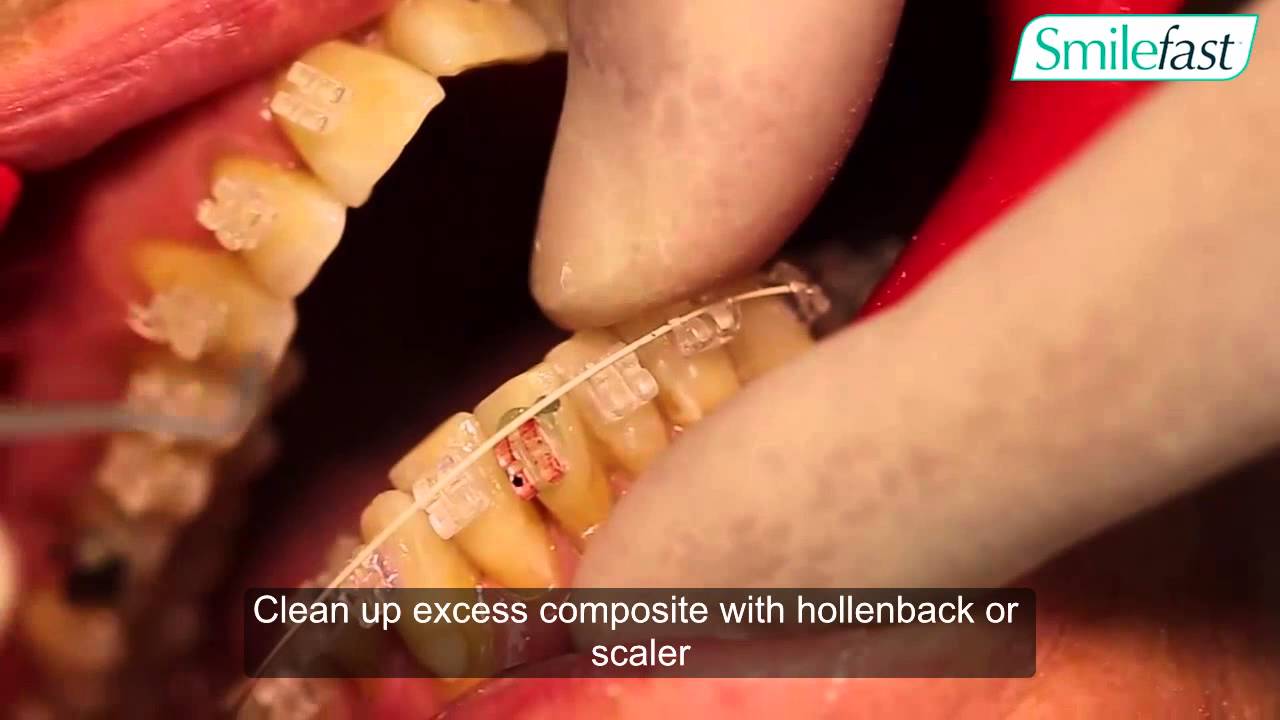 Smilefast Bracket ReBonding YouTube