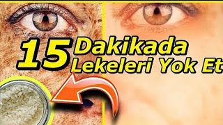 15 dakikada cilt lekeleri sivilce ve AKNE lekeleri nasıl geçer-CİLT BEYAZLATICI KREM