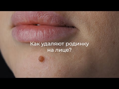 Удаление родинки на лице. Как это делают?