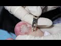 Ep_3109 Foot nails skin removal 👣 ใหญ่กว่าที่คิดครับ 😷 (This clip is from Thailand)