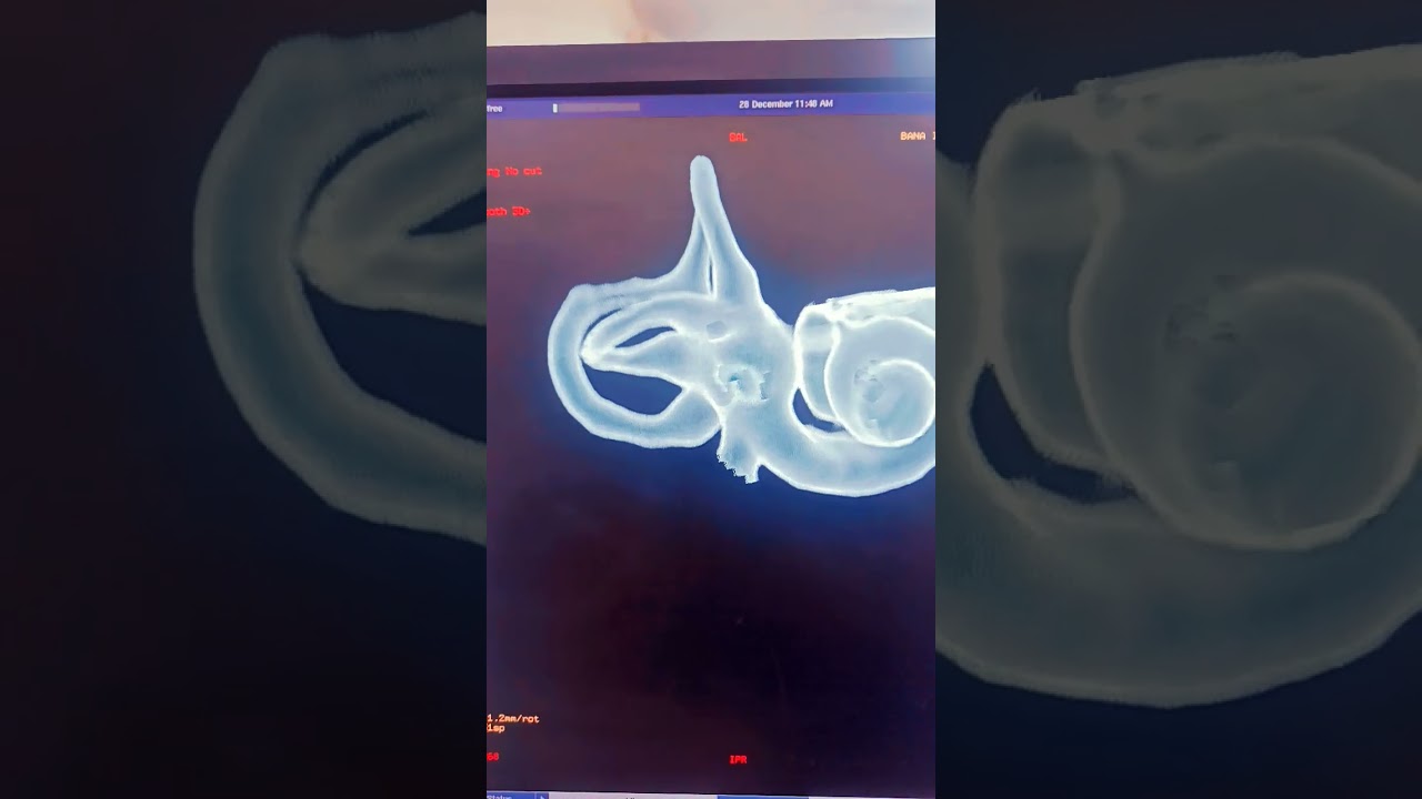 Kaise Hame Sunai Padta Hai? | Cochlea 3D CT Scan | Radiology 