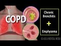 COPD - Chronic Obstructive Pulmonary Disease, Animation.