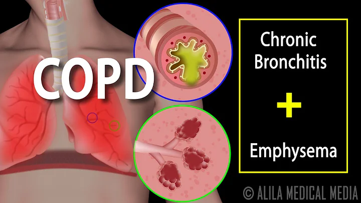 COPD - Chronic Obstructive Pulmonary Disease, Animation. - DayDayNews