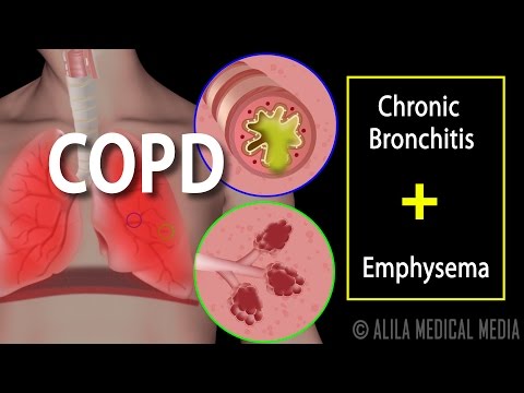 Video: Co je chronická obstrukční plicní nemoc (COPD)?