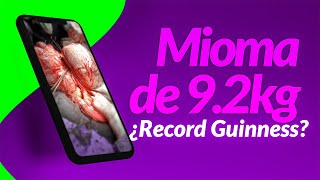Cirugía de Mioma de 9.2 kilos ¡Conservando el útero! ¿Es el record Guinness más grande?