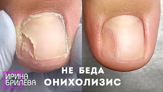 Педикюр БЕЗ ПАНИКИ!!! 😱 Онихолизис - это не страшно 🌸 КАК ОТРАСТИТЬ новый и здоровый ноготь