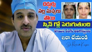 Best Solution for Mosquito Bite Allergy | Skin Care | Cetirizine Syrup | Dr. Ravikanth Kongara