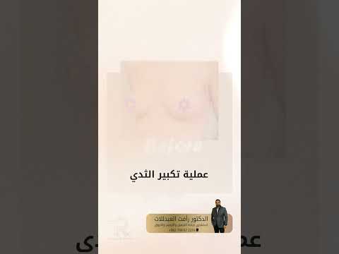 زراعة حشوات السيلكون لتكبير الصدر