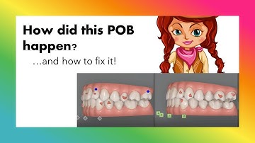 Invisalign ClinCheck - How Did This POB Happen?