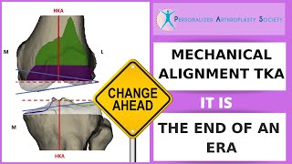 Mechanical Alignment for Total Knee Arthroplasty,  It is the End of an Era