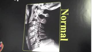 Chiropractor Coeur d'Alene ID | Underlying Cause of Migraine at Appleway Chiropractic