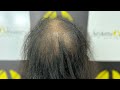 Best review for permenant hair extensions invisible ice gel capsule technique chennai karur hair