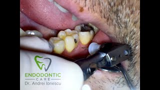Intraosseous Anaesthesia - (X tip) - Dr. Andrei Ionescu