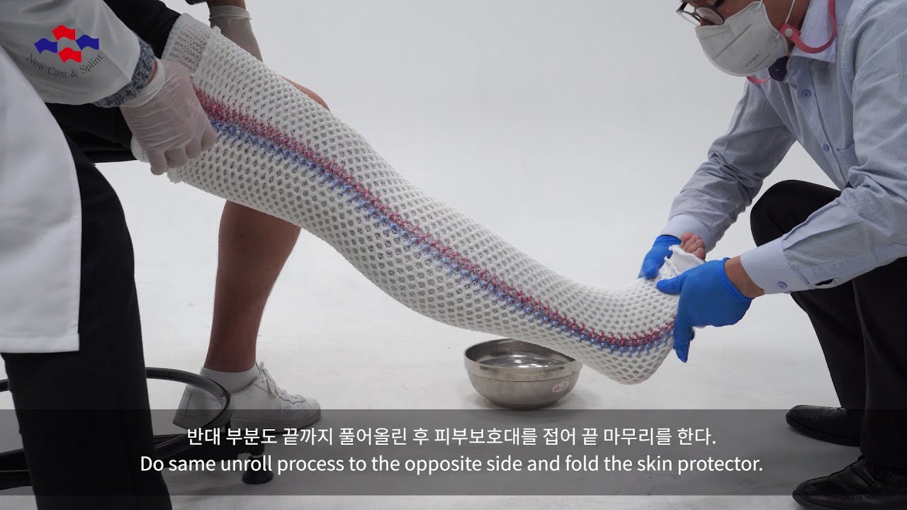 HM Cast procedure (Long leg)