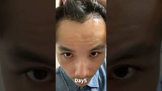 240天植髮紀錄｜240days hair transplant