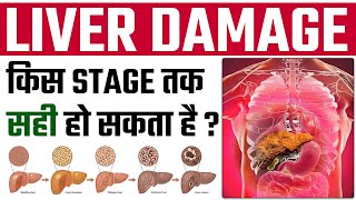 कब होता है Liver Failure  | 4 Stages Of Liver Disease And Treatment | SRIAAS