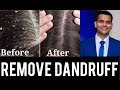 DANDRUFF TREATMENT || CAUSES AND HOME REMEDIES
