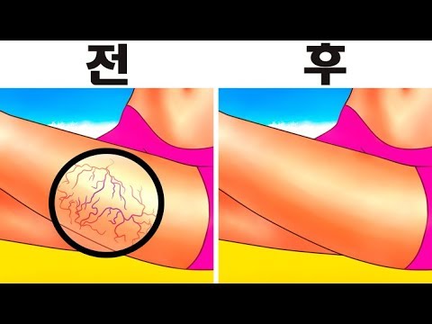 천연재료를 이용해 하지정맥류를 물리치는 8가지 방법