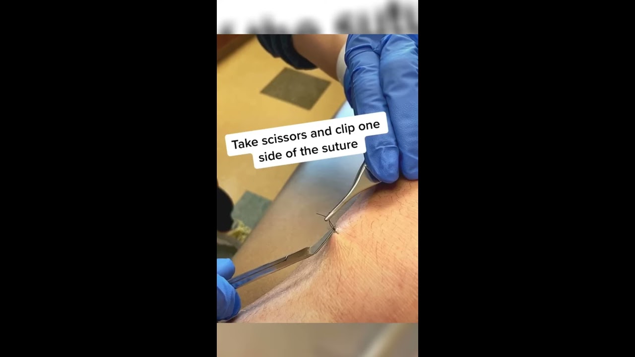 Suture Removal Instructional Video