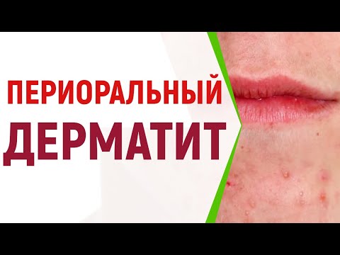 Периоральный дерматит