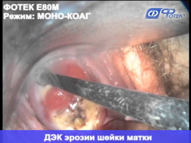 ДЭК при гиперкератозе шейки матки