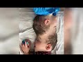頭部でつながった3歳の結合双生児、27時間の分離手術が成功　ブラジル