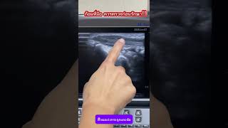 ก้อนที่มือ ควรตรวจก่อนรักษา!!