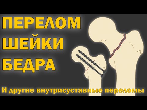 Перелом шейки бедра, мыщелковый перелом, перелом локтя, частичное протезирование [S05E16]