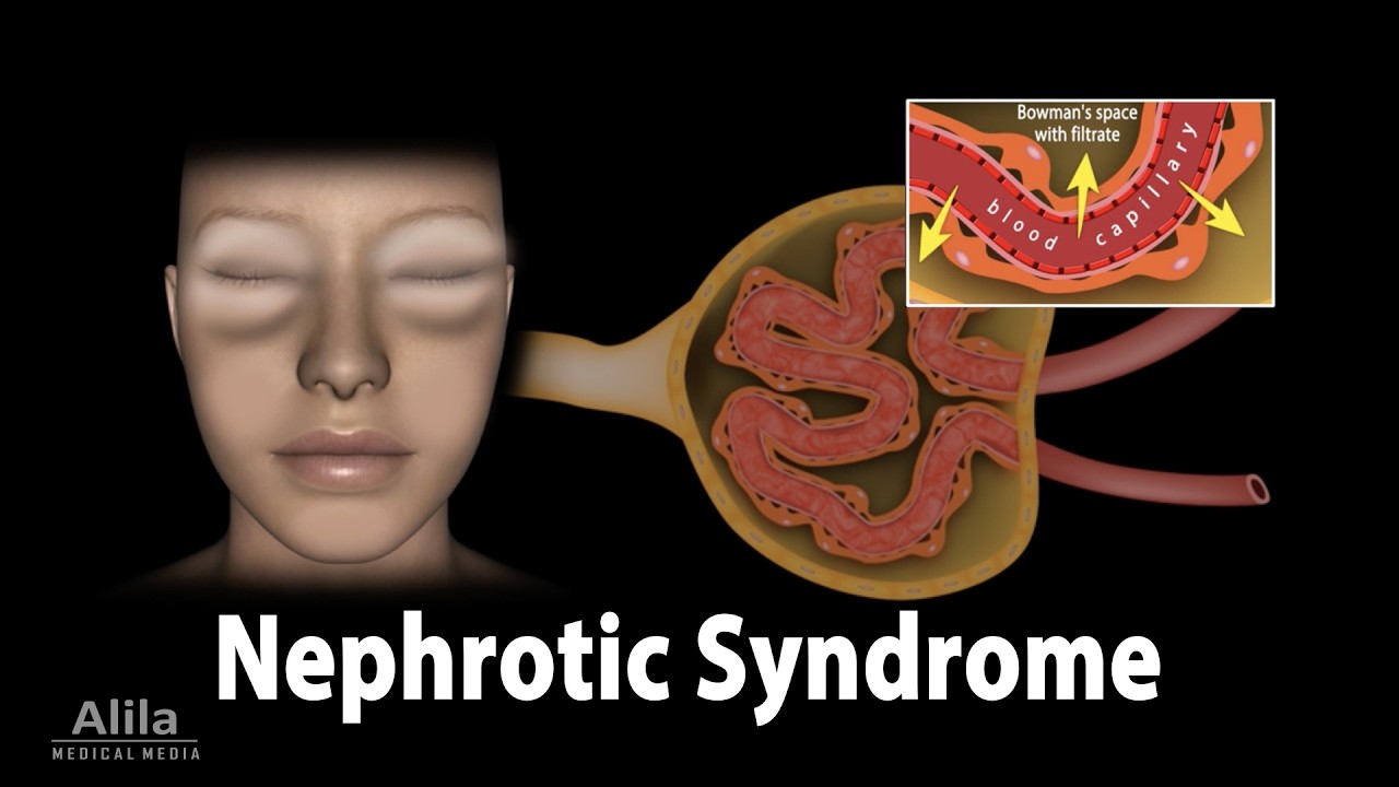Nephrocity Nephrotic Syndrome: Pathophysiology, Causes, Symptoms, Diagnosis and ...