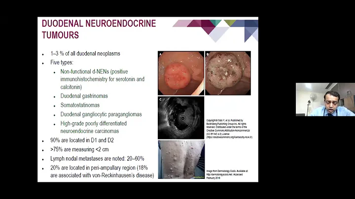 Gastrointestinal Neuroendocrine Tumor: Diagnosis and Management_Dr Manish Singhal