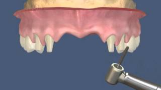 видео Протезирование передних верхних зубов