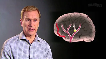 Varför ger en skada i vänster hjärnhalva förlamning i höger kroppshalva?