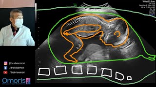 Ultrasound BABY SEX! Boy or girl? Pregnancy 20 weeks. screenshot 1