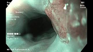 Ectopia of gastric mucosa in proximal esophagus Желудочна эктопия в проксимальной части пищевода Ectopia of gastric mucosa in proximal esophagus Желудочна эктопия в проксимальной части пищевода