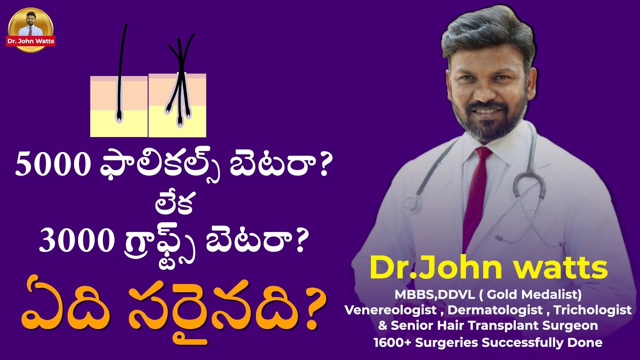5000 Follicles v/s 3000 Grafts Which is the Best Option? | Dr.John Watts