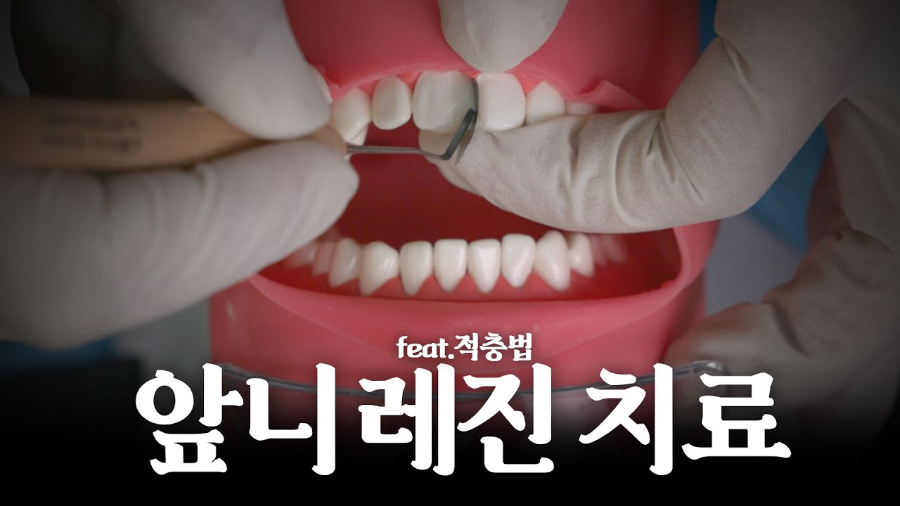 벌어진 앞니를 레진으로 치료하는 과정, 전부 보여드립니다.