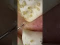 blackhead removal from nose/ old aged blackheads removal