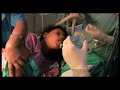 Chapter 3 7 extubation nepal