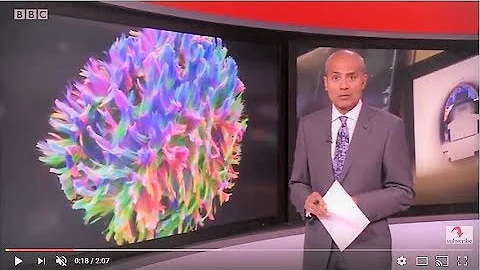 Amazing New Brain Scanner on BBC News