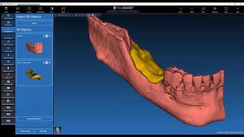 Model a bone graft in 5 minutes with RealGUIDE 5.0