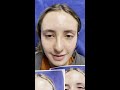 Septorhinoplasty/Sinus Surgery 7 days ago—doing well