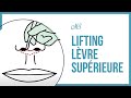 Lifting de la lvre suprieure animation ou lip lift animation dr mark samaha montral