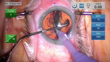 Learning a New Way to Phaco Chop: A Step-by-Step Explanation of Chopper and Phaco Tip Positioning