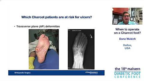 Dane Wukich - When to operate on a Charcot foot?