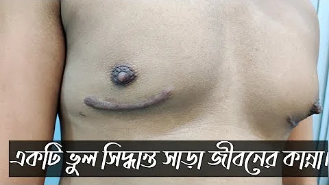 অপারেশন করানো জীবনের সব চেয়ে বড় ভুল ||  Gynecomastia  || পুরুষের বড় স্তন || ছেলেদের স্তন ||