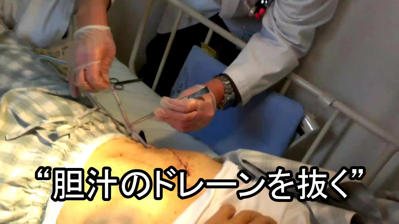 “胆汁のドレーンを抜く”胆嚢摘出手術にて YouTube “胆汁のドレーンを抜く”胆嚢摘出手術にて YouTube