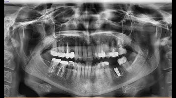 Immediate Implant In Fresh Socket with Periapical Lesion /زراعة فورية في منطقة مصابة بافة ذروية